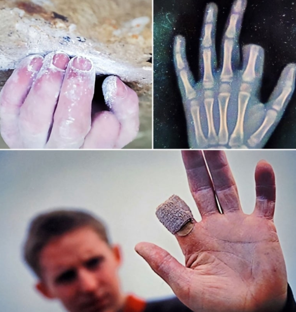 ⓒ토미 콜드웰은 왼손 검지 손가락이 없다